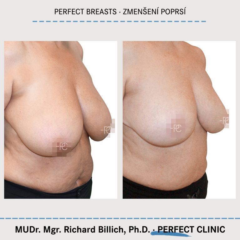 Zmenšení prsou