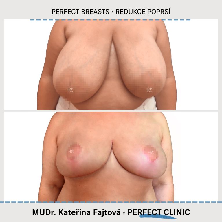 Zmenšení prsou
