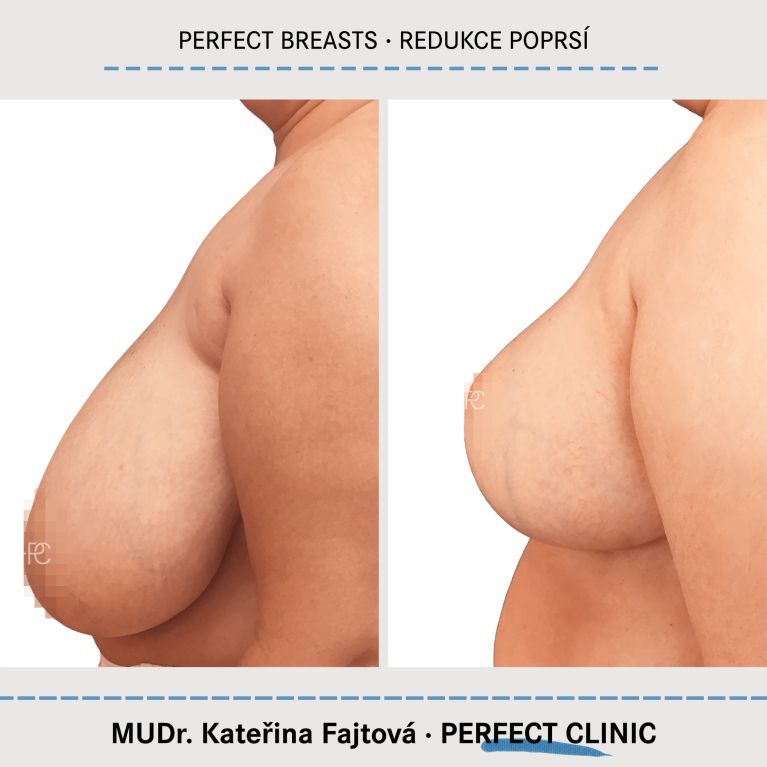Zmenšení prsou