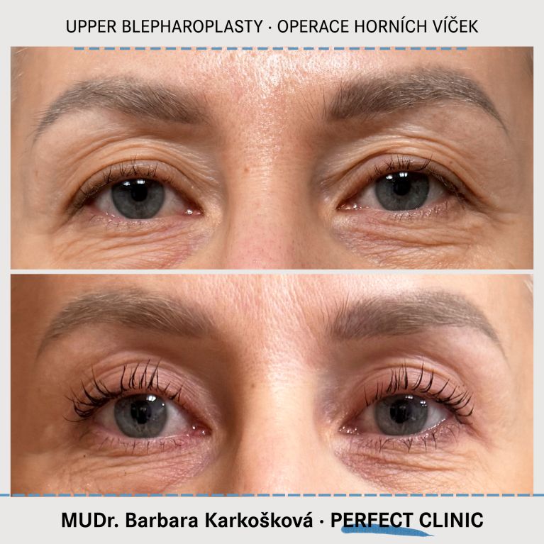 Operace horních víček