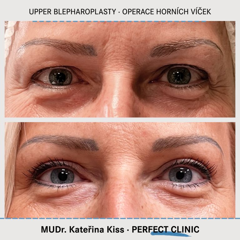 Operace horních víček