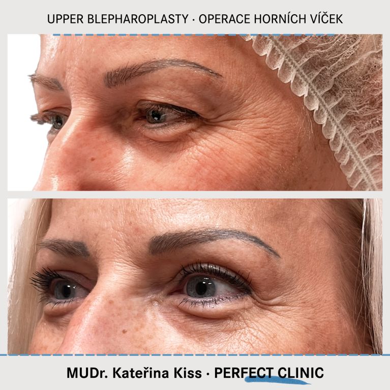 Operace horních víček