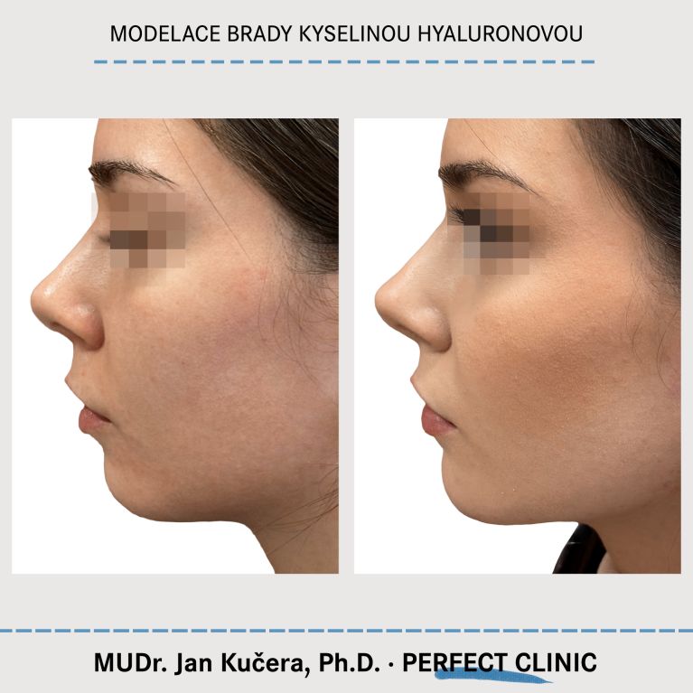 Injekční výplně kyselinou hyaluronovou