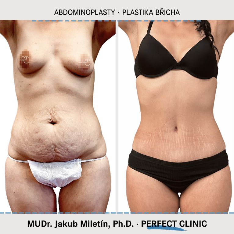Abdominoplastika