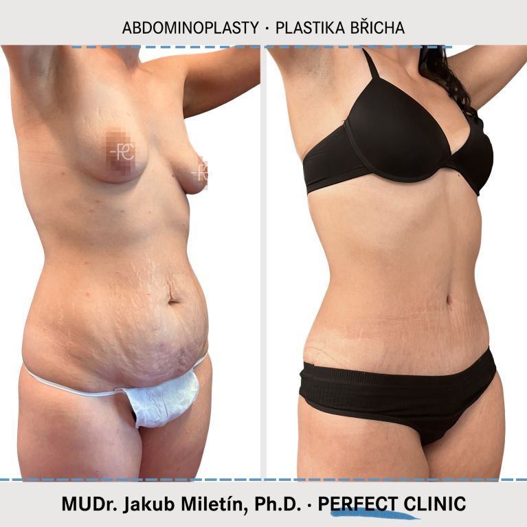 Abdominoplastika