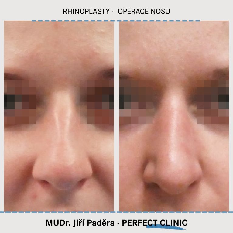 Rhinoplastika