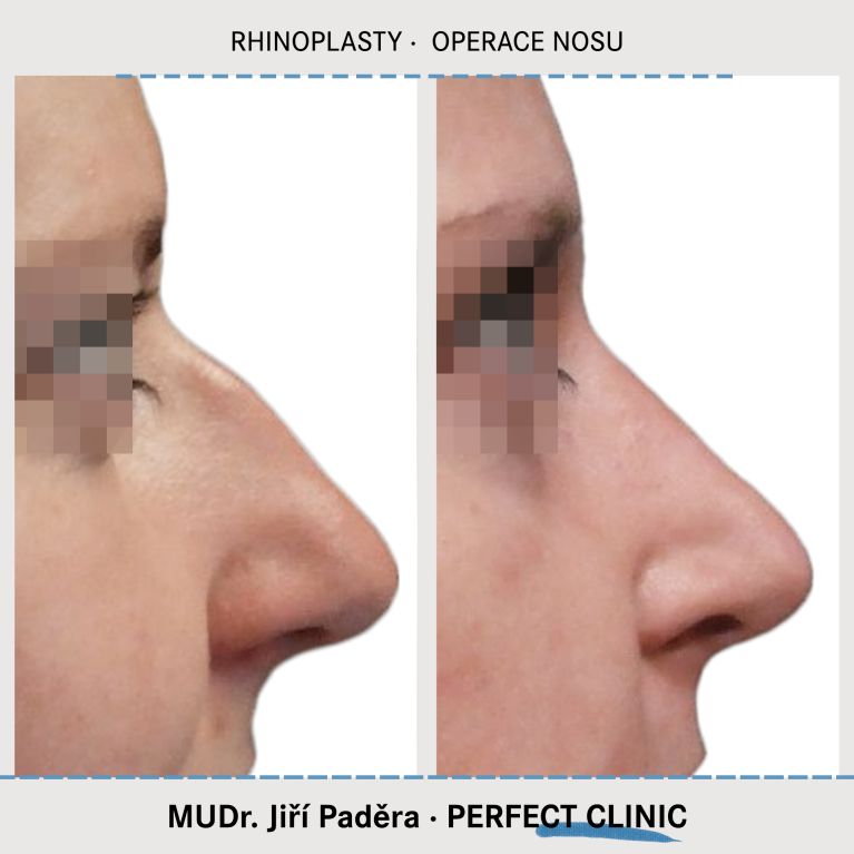 Rhinoplastika