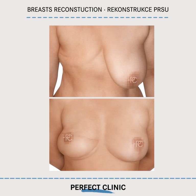 Rekonstrukce prsou