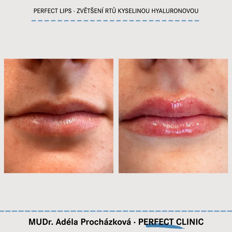 Zvětšení rtů kyselinou hyaluronovou