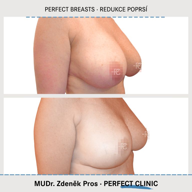 Zmenšení prsou