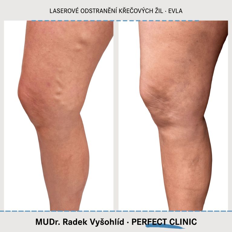 EVLA – Endovenózní laserová ablace