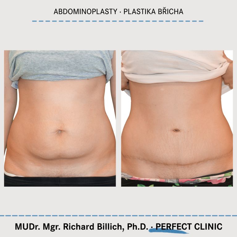 Abdominoplastika