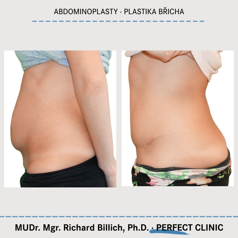 Abdominoplastika
