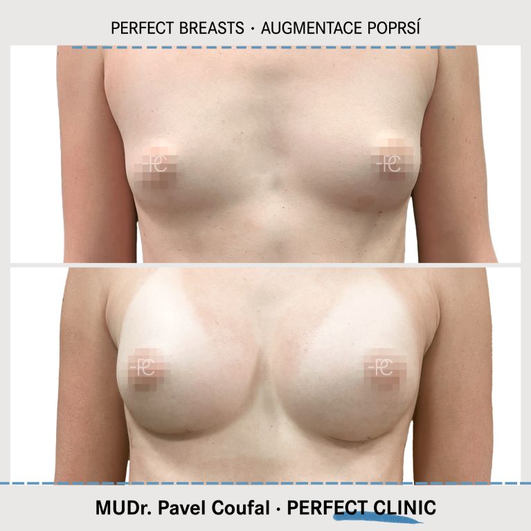 Augmentace poprsí