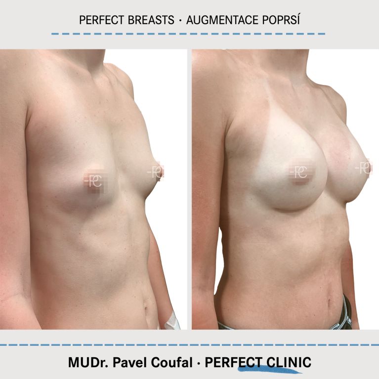 Augmentace poprsí