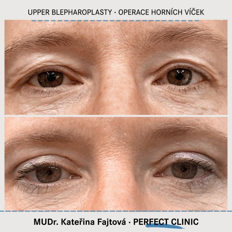 Operace horních víček