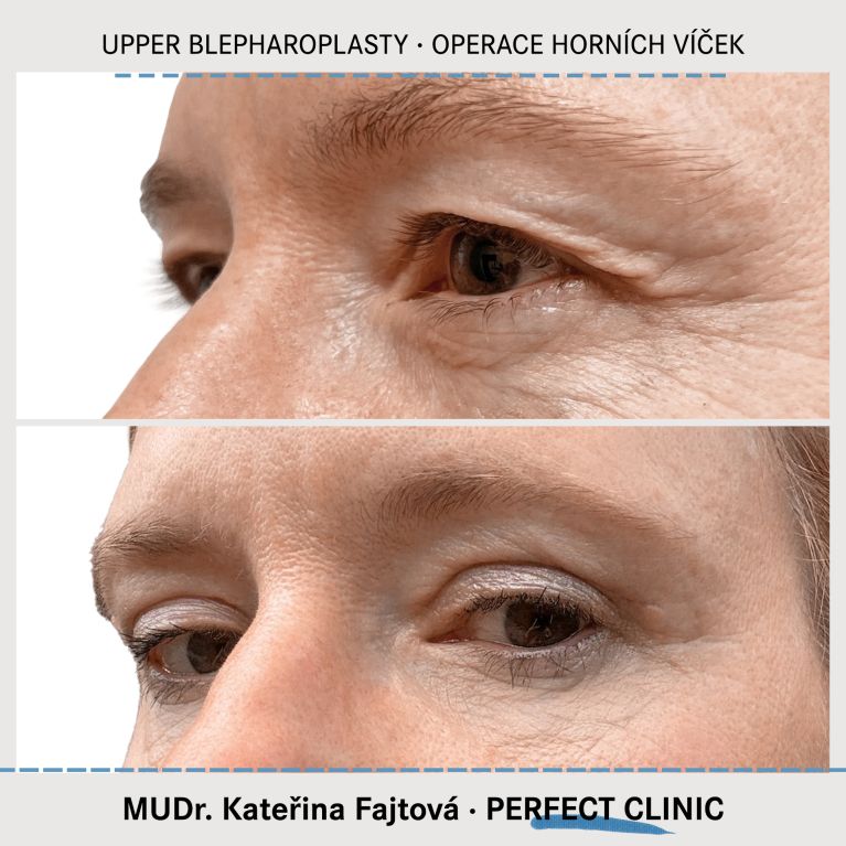 Operace horních víček