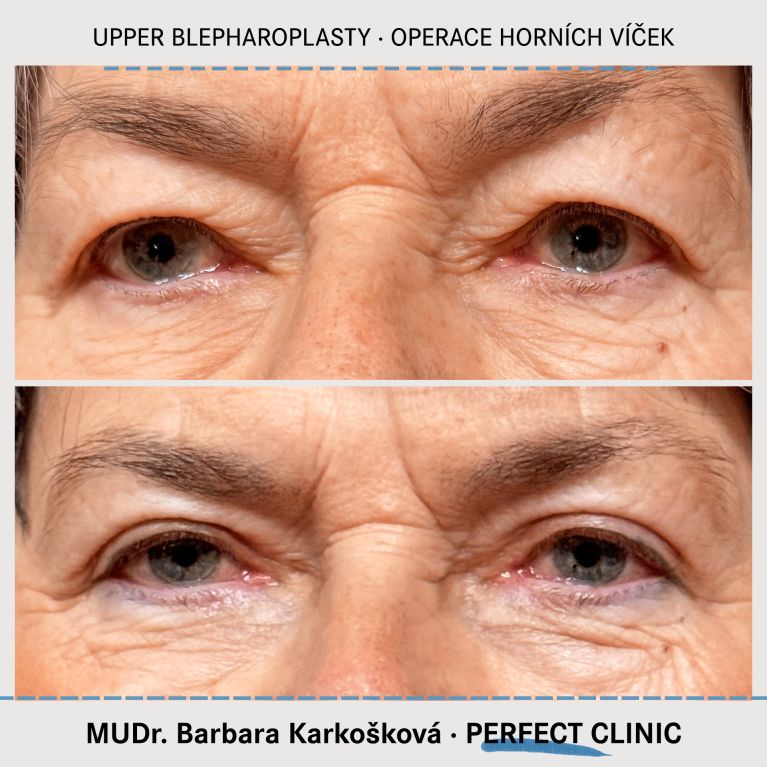 Operace horních víček