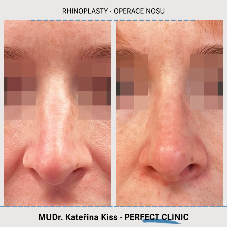 Rhinoplastika