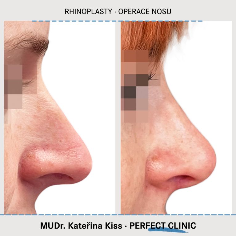 Rhinoplastika
