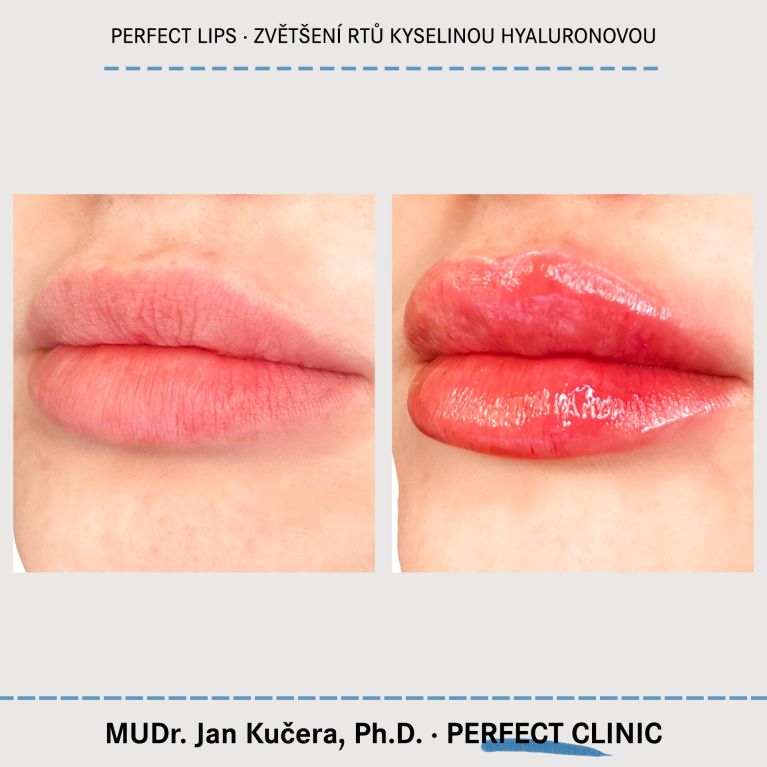 Zvětšení rtů kyselinou hyaluronovou