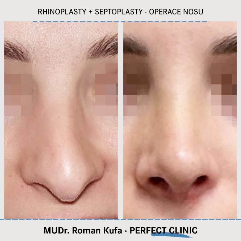 Rhinoplastika