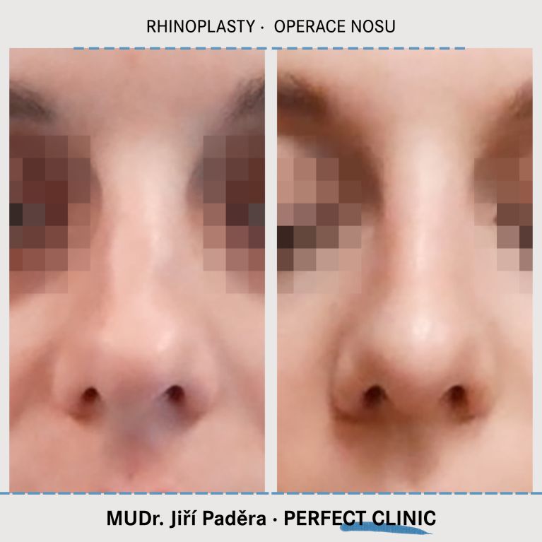Rhinoplastika