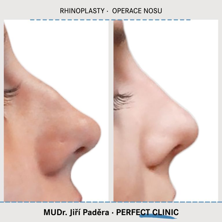 Rhinoplastika