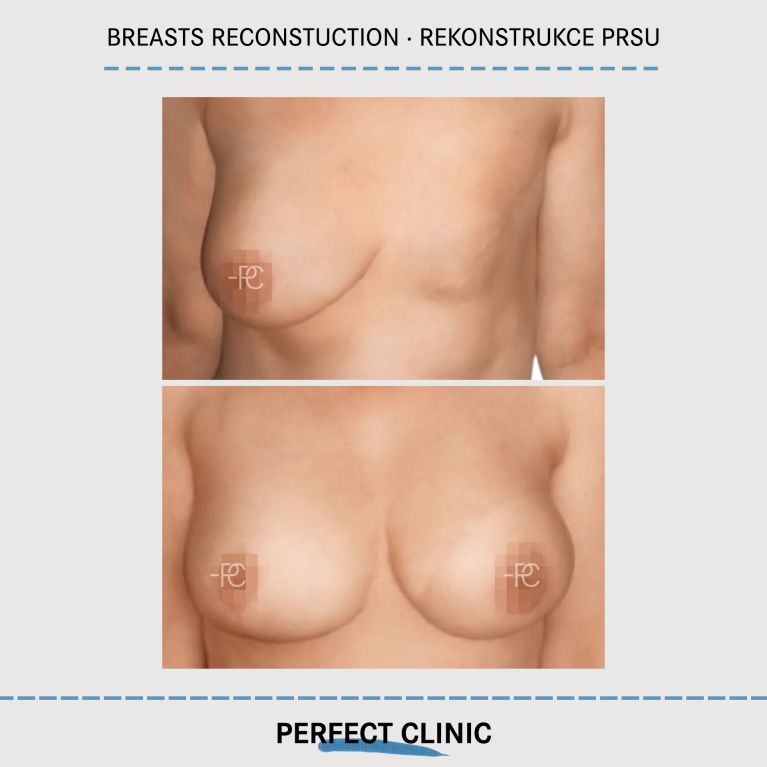 Rekonstrukce prsou