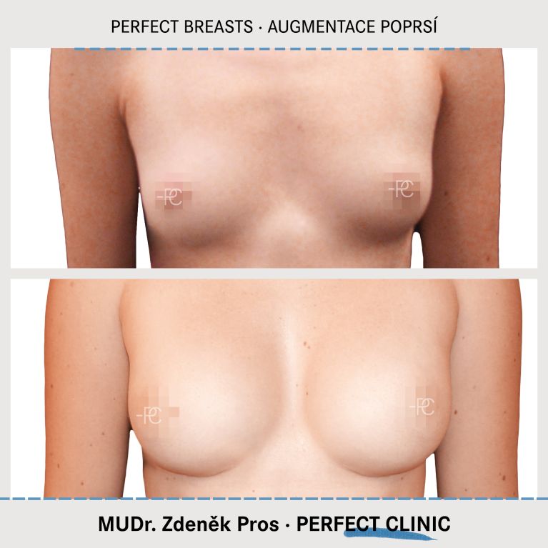 Augmentace poprsí