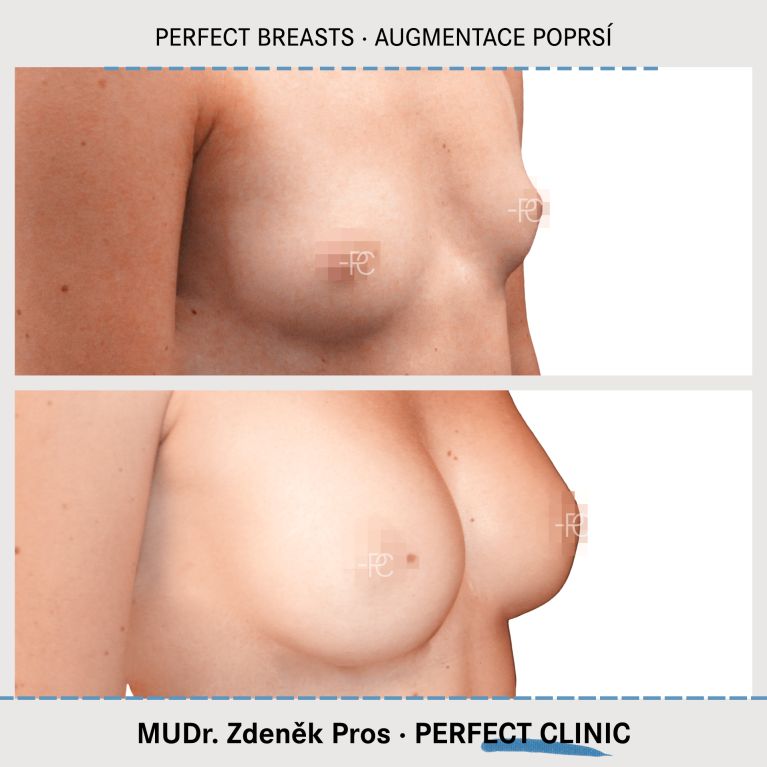 Augmentace poprsí