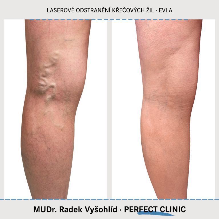 EVLA – Endovenózní laserová ablace