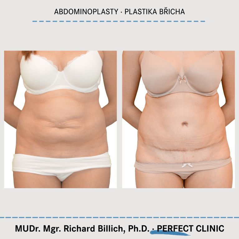 Abdominoplastika