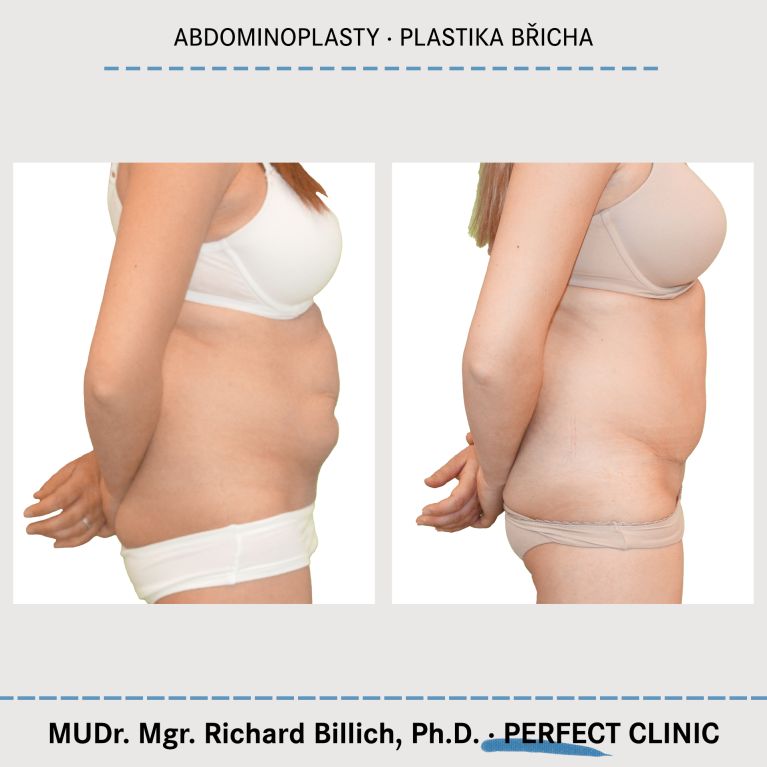 Abdominoplastika