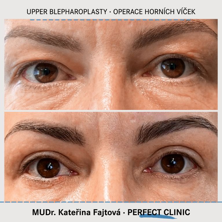 Operace horních víček