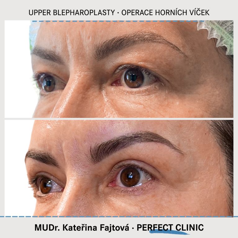 Operace horních víček