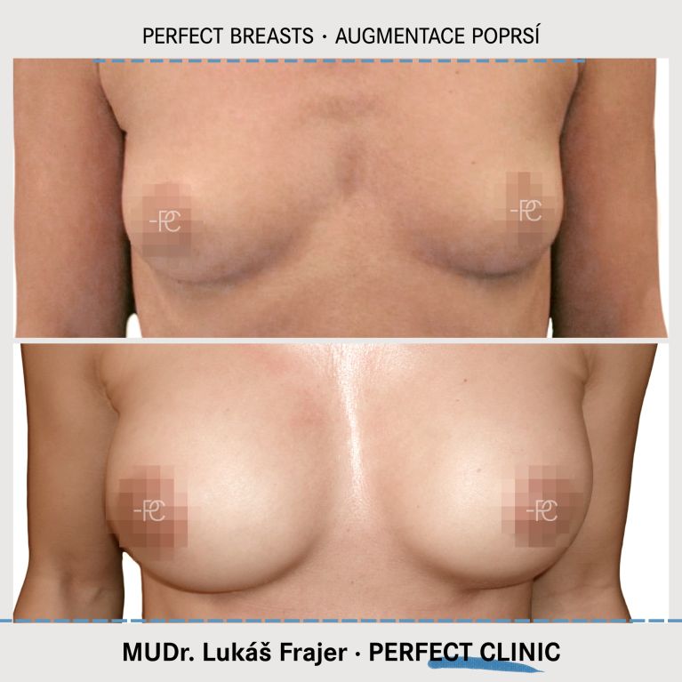 Augmentace poprsí