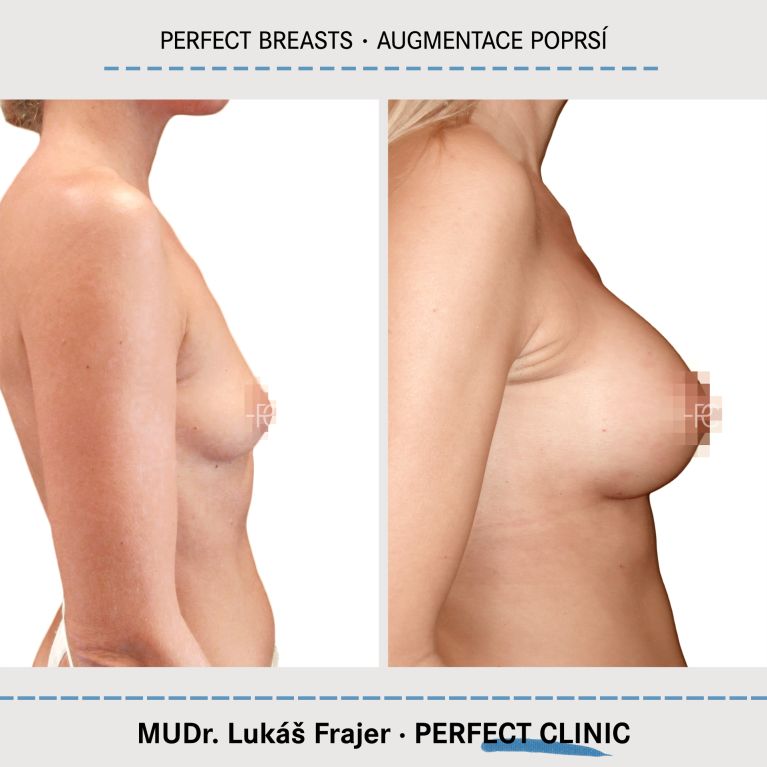 Augmentace poprsí