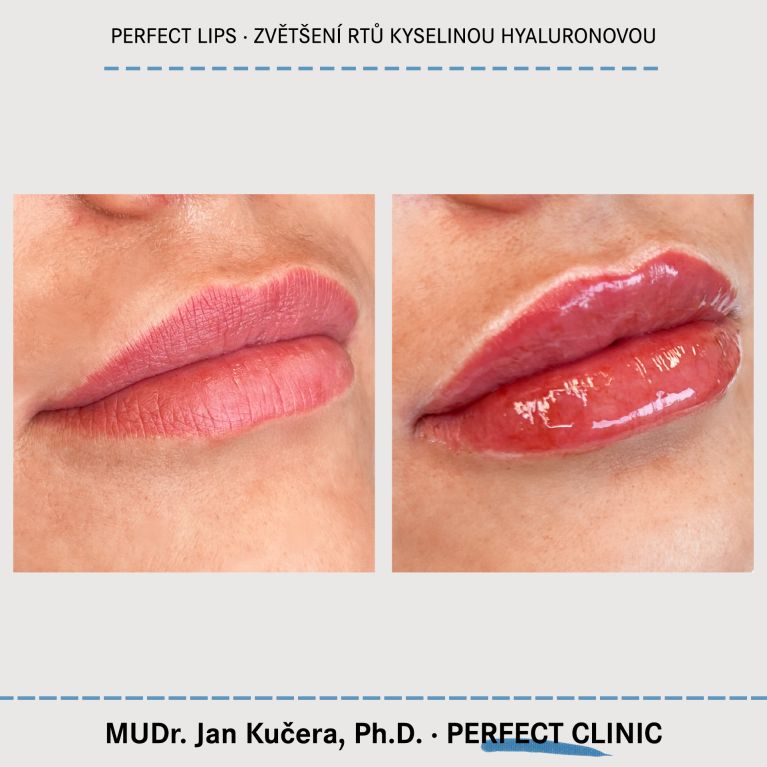 Zvětšení rtů kyselinou hyaluronovou