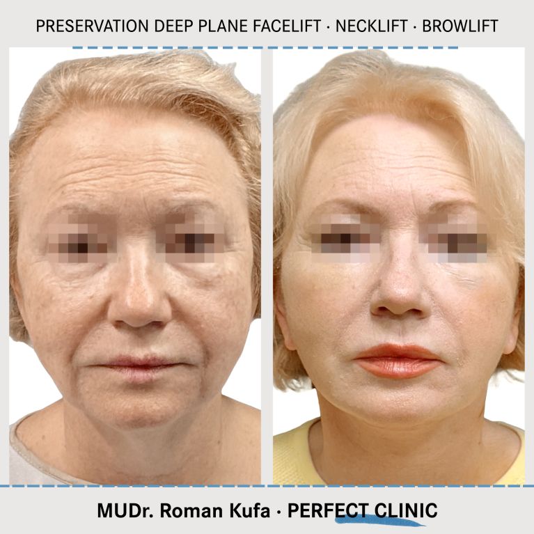 Facelift • Necklift • Browlift