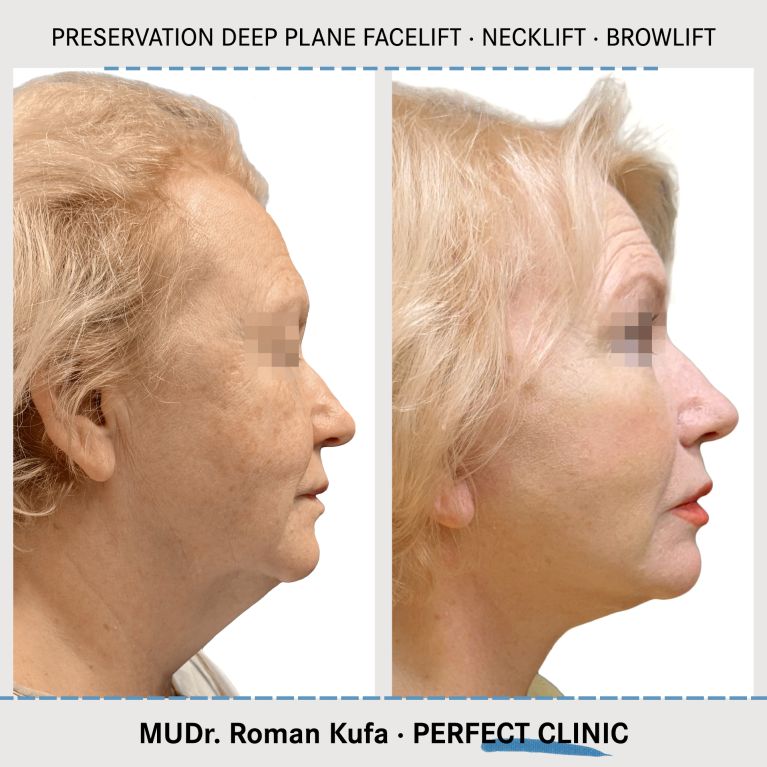 Facelift • Necklift • Browlift