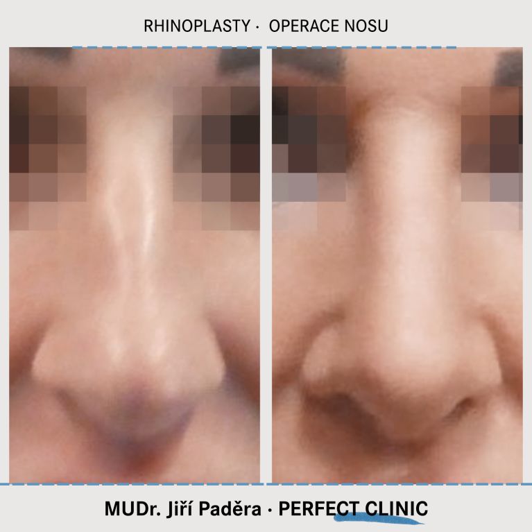 Rhinoplastika