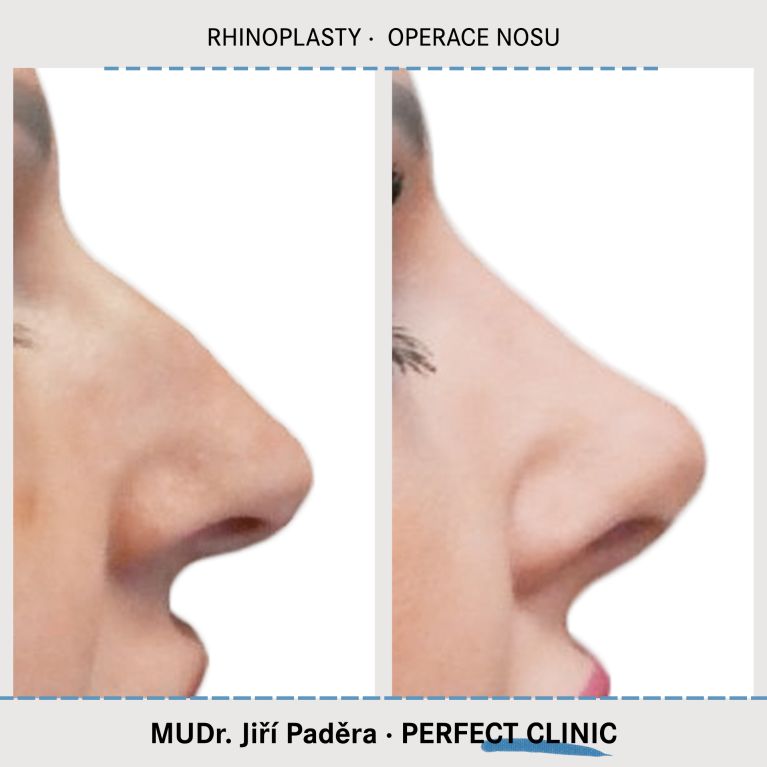 Rhinoplastika