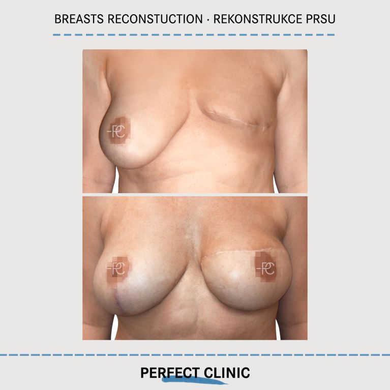 Rekonstrukce prsou