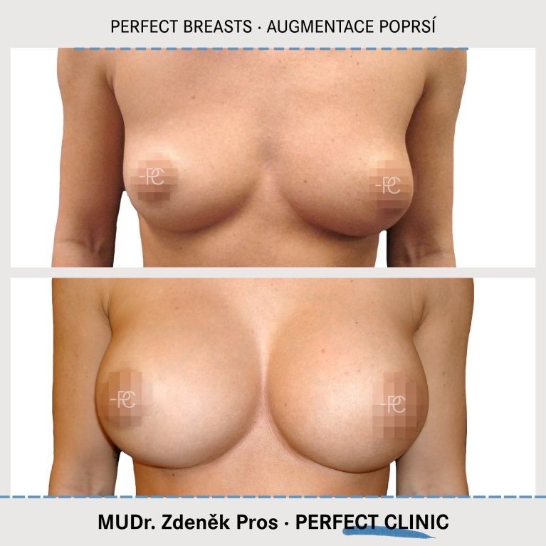 Augmentace poprsí