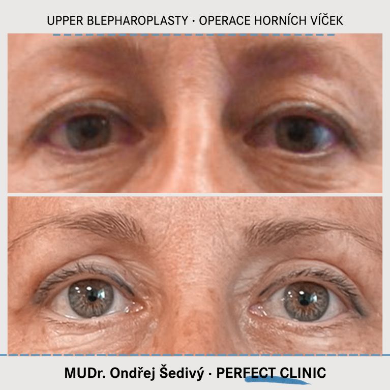 Operace horních víček