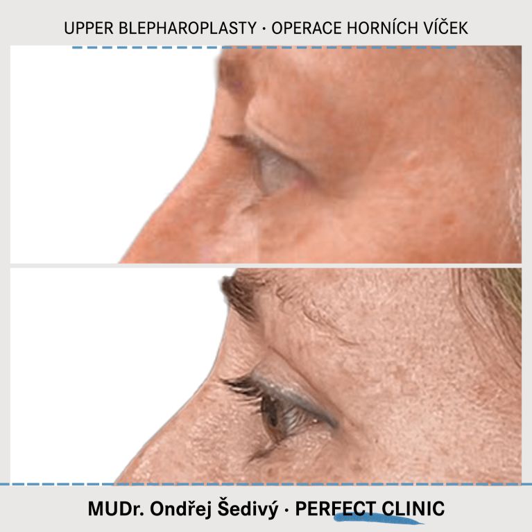 Operace horních víček