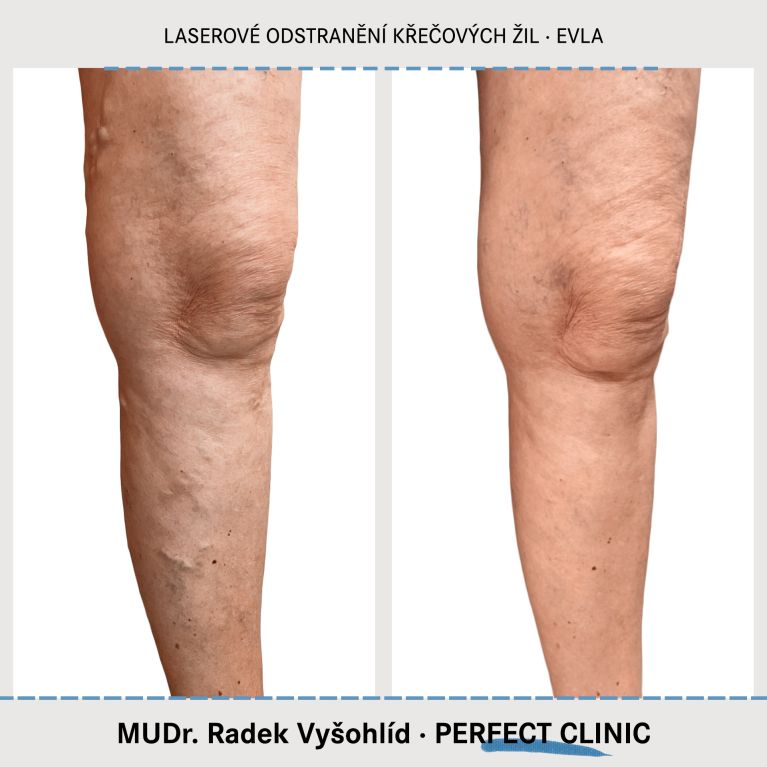 EVLA – Endovenózní laserová ablace