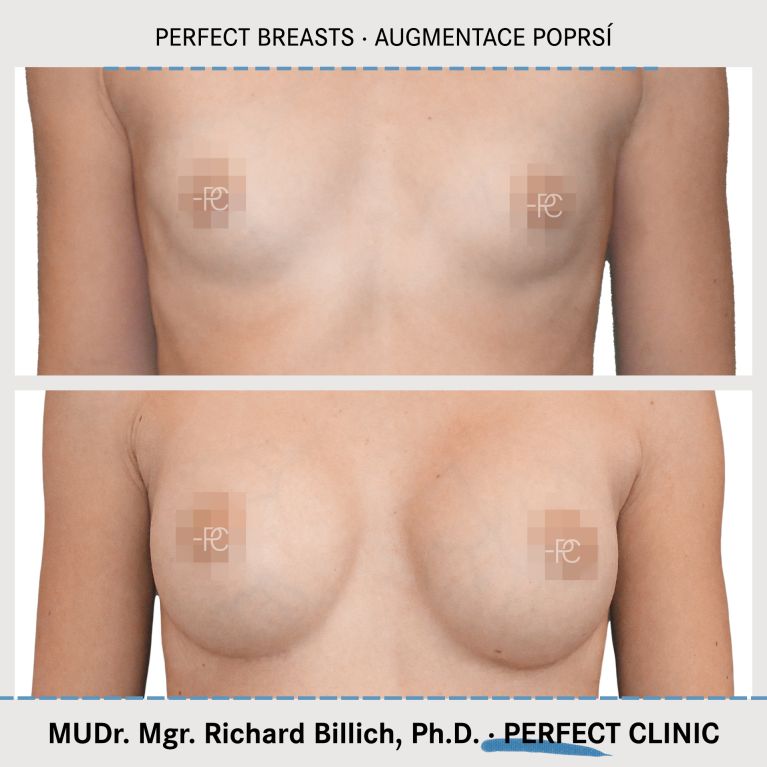 Augmentace poprsí