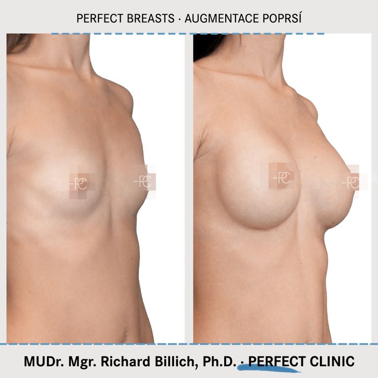 Augmentace poprsí